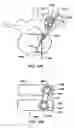 Fig. 09 - MIS crosslink apparatus and methods for spinal implant