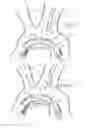 Fig. 06 - Branched stent graft system