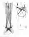 Fig. 05 - Real image forming eye examination lens utilizing two reflecting surfaces
