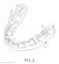 Fig. 08 - Bone conduction hearing device with open-ear microphone