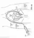 Fig. 08 - Forming Embolic Particles