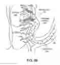 Fig. 09 - Forming Embolic Particles