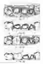 Fig. 02 - Method for designing a plurality of adjacent tooth restorations using CAD/CAM technology