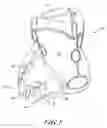 Fig. 02 - Implantable device for treatment of ventricular dilation