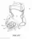 Fig. 11 - Implantable device for treatment of ventricular dilation