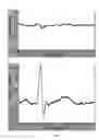 Fig. 06 - METHOD FOR GENERATING THREE STANDARD SURFACE ECG LEADS DERIVED FROM THREE ELECTRODES CONTAINED IN THE MID-HORIZONTAL PLANE OF THE TORSO