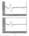 Fig. 07 - METHOD FOR GENERATING THREE STANDARD SURFACE ECG LEADS DERIVED FROM THREE ELECTRODES CONTAINED IN THE MID-HORIZONTAL PLANE OF THE TORSO