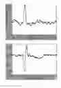 Fig. 08 - METHOD FOR GENERATING THREE STANDARD SURFACE ECG LEADS DERIVED FROM THREE ELECTRODES CONTAINED IN THE MID-HORIZONTAL PLANE OF THE TORSO