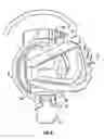 Fig. 07 - STATIC PROGRESSIVE PRONATION SUPINATION SPLINT