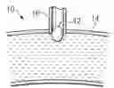 Fig. 01 - System and method for providing an obturator for enhanced directional capabilities in a vascular environment