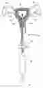 Fig. 01 - Uterine therapy device and method