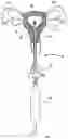 Fig. 01 - Uterine therapy device and method