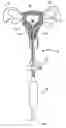 Fig. 01 - Uterine therapy device and method
