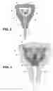 Fig. 03 - Uterine therapy device and method