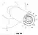 Fig. 17 - Uterine therapy device and method