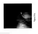 Fig. 04 - Guide-wire sleeve for facilitation of lesion crossing