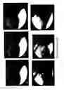 Fig. 11 - Guide-wire sleeve for facilitation of lesion crossing