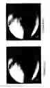 Fig. 12 - Guide-wire sleeve for facilitation of lesion crossing