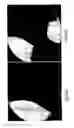 Fig. 14 - Guide-wire sleeve for facilitation of lesion crossing