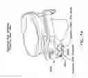 Fig. 43 - Method and apparatus for performing an open wedge, high tibial osteotomy