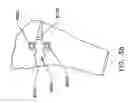 Fig. 47 - Method and apparatus for performing an open wedge, high tibial osteotomy