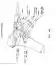Fig. 49 - Method and apparatus for performing an open wedge, high tibial osteotomy