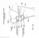Fig. 53 - Method and apparatus for performing an open wedge, high tibial osteotomy