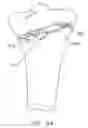 Fig. 63 - Method and apparatus for performing an open wedge, high tibial osteotomy