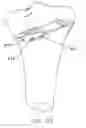 Fig. 64 - Method and apparatus for performing an open wedge, high tibial osteotomy