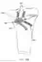 Fig. 67 - Method and apparatus for performing an open wedge, high tibial osteotomy