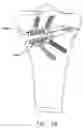 Fig. 68 - Method and apparatus for performing an open wedge, high tibial osteotomy
