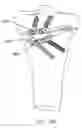 Fig. 69 - Method and apparatus for performing an open wedge, high tibial osteotomy
