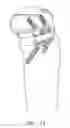 Fig. 72 - Method and apparatus for performing an open wedge, high tibial osteotomy