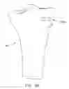 Fig. 75 - Method and apparatus for performing an open wedge, high tibial osteotomy