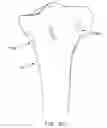 Fig. 76 - Method and apparatus for performing an open wedge, high tibial osteotomy