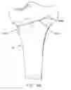 Fig. 77 - Method and apparatus for performing an open wedge, high tibial osteotomy