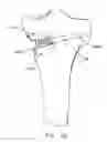 Fig. 79 - Method and apparatus for performing an open wedge, high tibial osteotomy