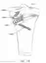 Fig. 82 - Method and apparatus for performing an open wedge, high tibial osteotomy