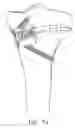 Fig. 83 - Method and apparatus for performing an open wedge, high tibial osteotomy