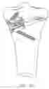Fig. 84 - Method and apparatus for performing an open wedge, high tibial osteotomy