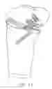 Fig. 86 - Method and apparatus for performing an open wedge, high tibial osteotomy