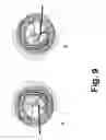 Fig. 10 - Methods and devices for eye surgery