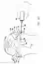 Fig. 32 - Surgical threading device and method for using same