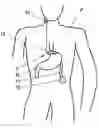 Fig. 01 - Controllable stomach band