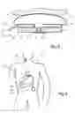 Fig. 04 - Controllable stomach band