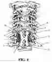 Fig. 05 - Anterior cervical staple