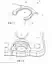 Fig. 06 - Anterior cervical staple