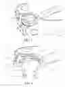 Fig. 07 - Anterior cervical staple