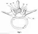 Fig. 02 - Spline Implant