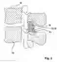 Fig. 04 - Spline Implant